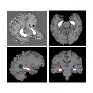 Figure 1 - The hippocampus is shown in white in different views of a single individual on these MRI’s.  